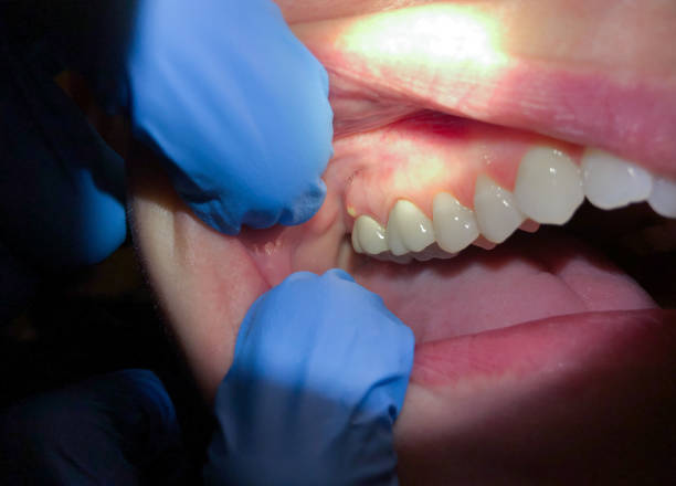 Best Emergency Wisdom Teeth Removal in Pen Argyl, PA