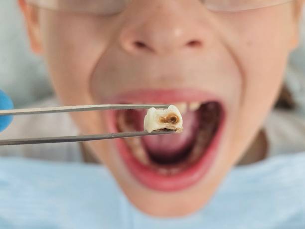 Best Emergency Tooth Extraction in Pen Argyl, PA